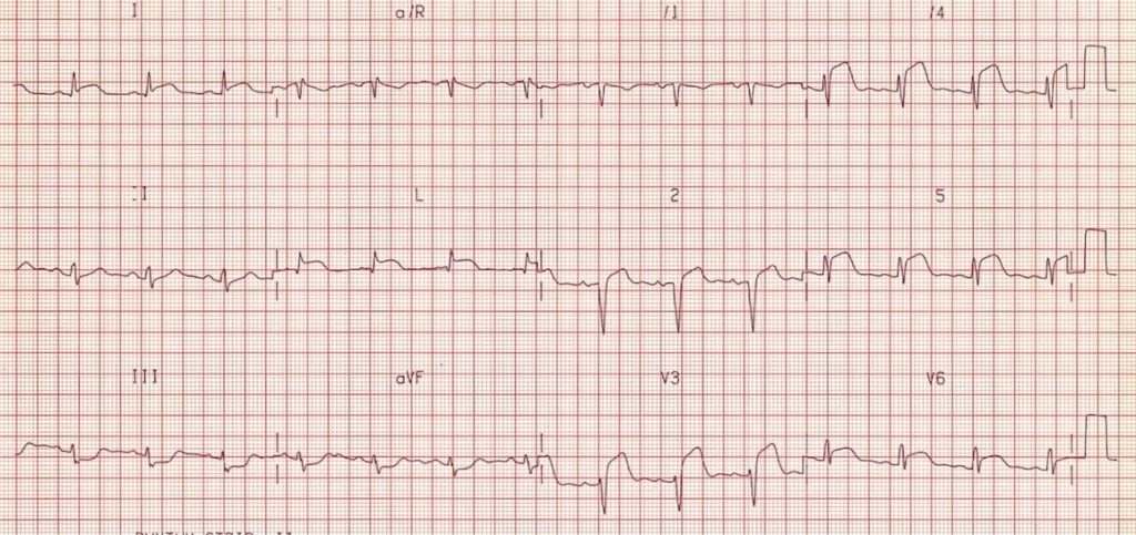 ECG (EKG) examples and quiz - Oxford Medical Education