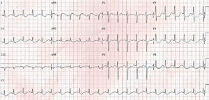 ECG (EKG) Examples And Quiz - Oxford Medical Education