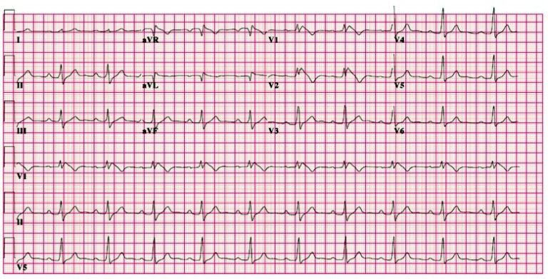 ECG (EKG) examples and quiz - Oxford Medical Education