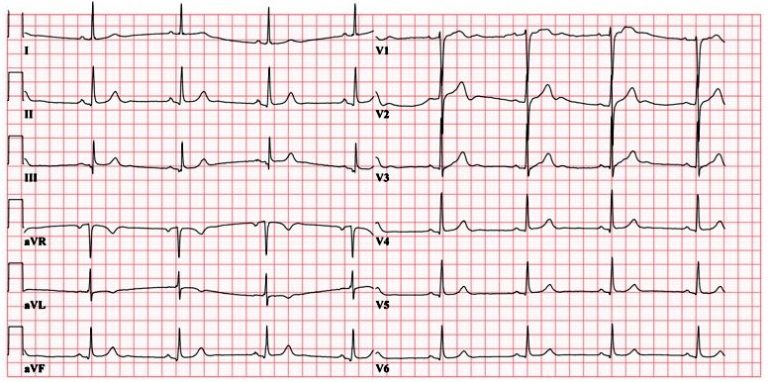 ECG (EKG) examples and quiz - Oxford Medical Education