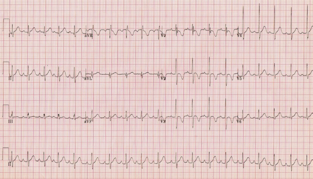 Blok Prawej Odnogi Peczka Hisa Ekg EKG (EKG) - blok odnogi pęczka Hisa - Oxford Medical Education | Carlos Ramirez