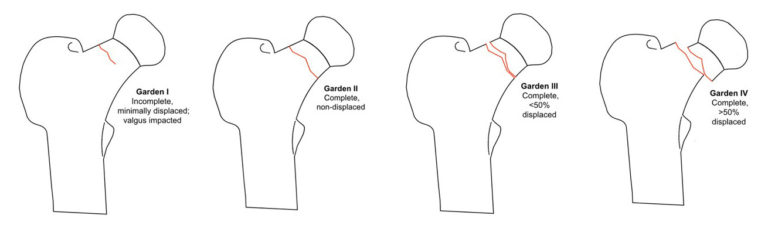 Hip Fractures: Intracapsular Neck of Femur Fractures - Oxford Medical ...