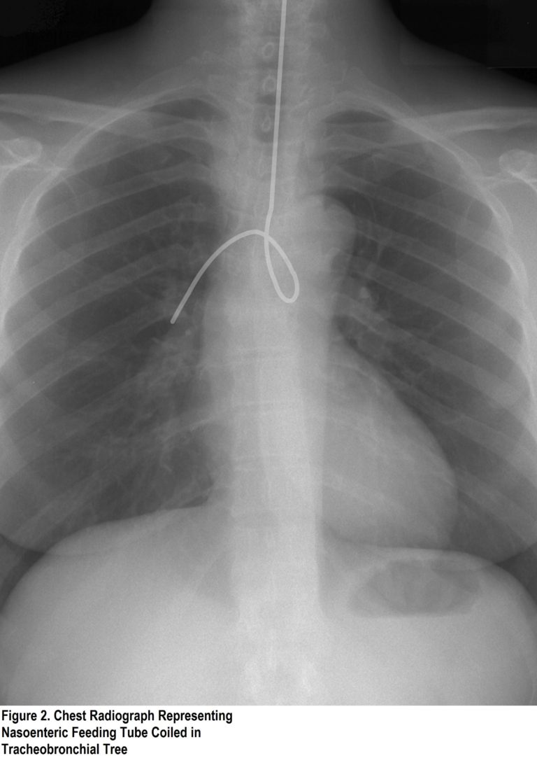 nasogastric-ng-tube-placement-oxford-medical-education